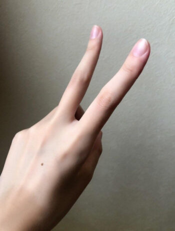 嘉喜遥香の手の甲のあざ4
